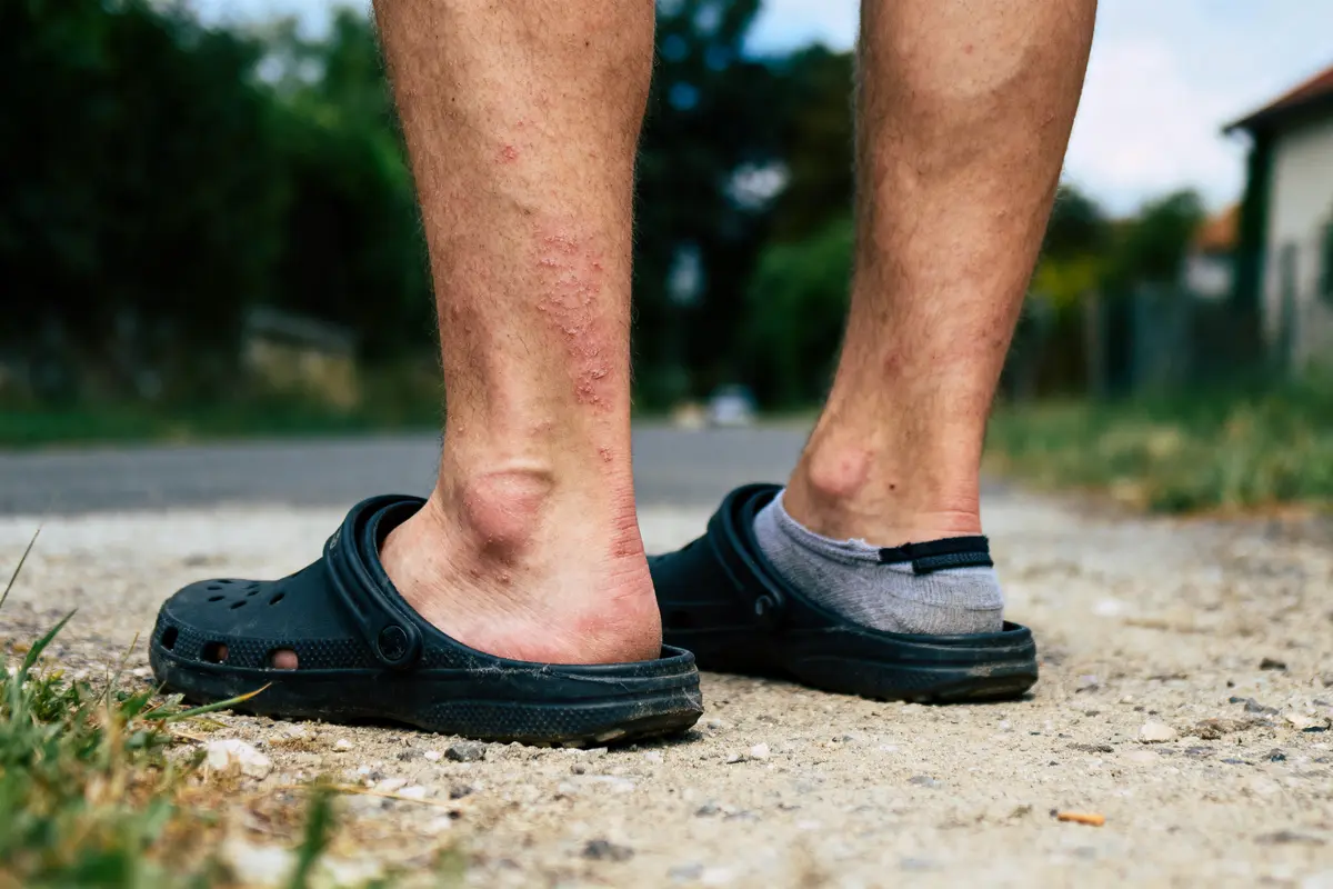 Jambes avec irritations cutanées, portant des sandales noires et chaussettes grises, en extérieur.