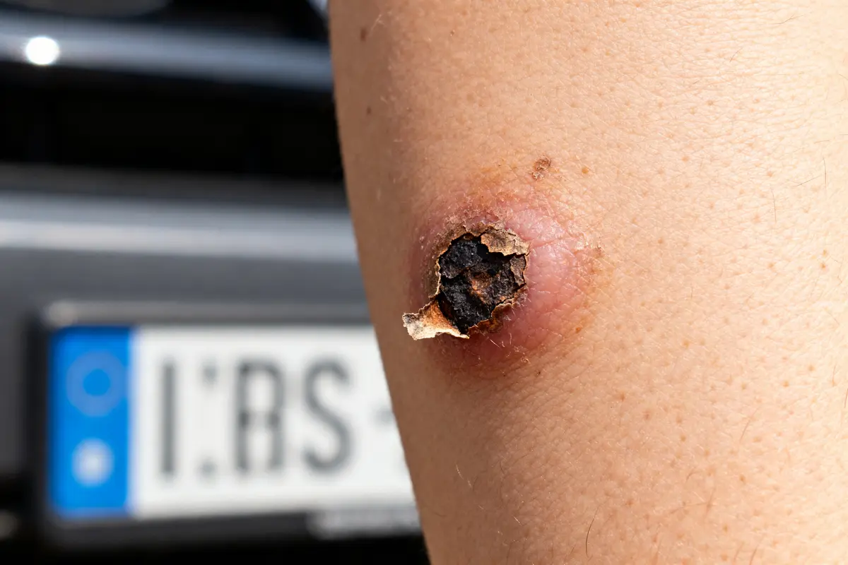 Verrue morte : Comment savoir si elle est bien disparue ?
